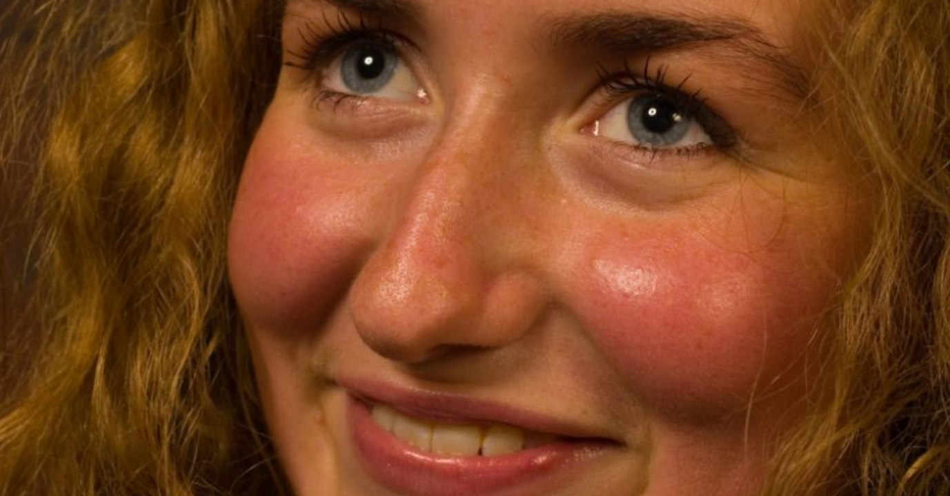 Diese Krankheit kann dahinter stecken, wenn du beim Trinken gleich rot anläufst