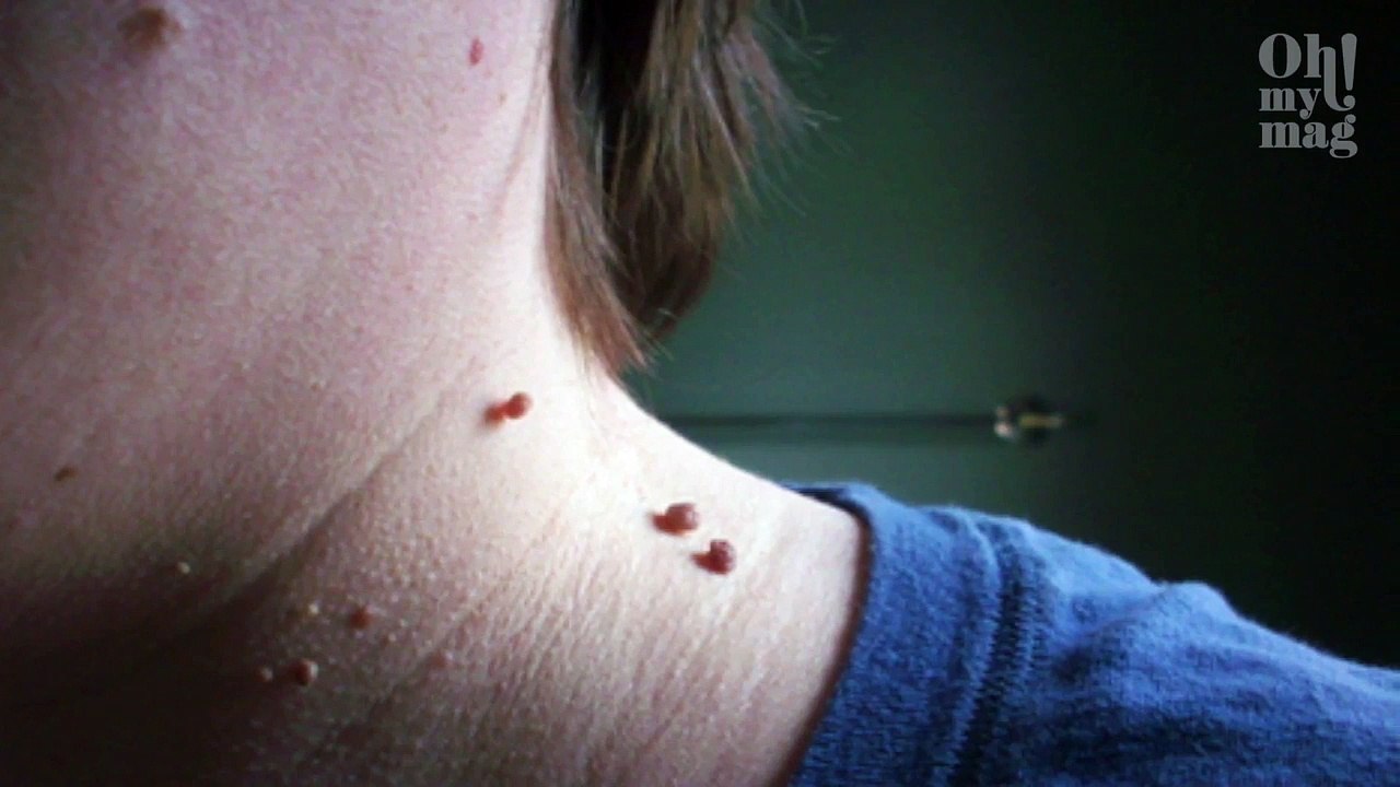 Stielwarzen: Es gibt eine einfache Art, solche Warzen loszuwerden