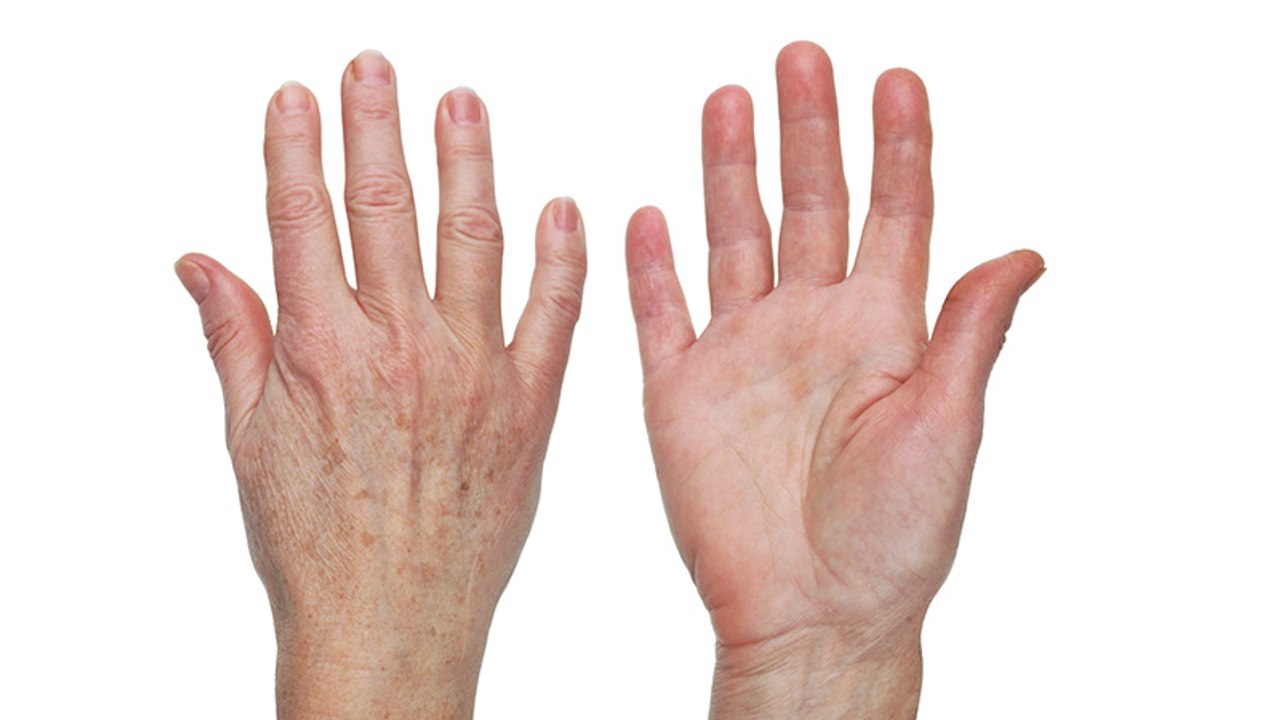 Altersflecken: Mit zwei natürlichen Zutaten wirst du sie schnell los