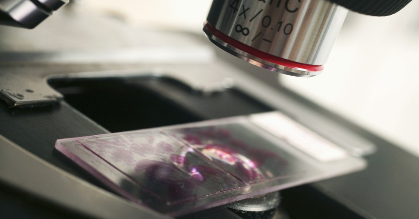 Krebsforschung: Ein bestimmtes Lebensmittel regt das Wachstum von Krebszellen an