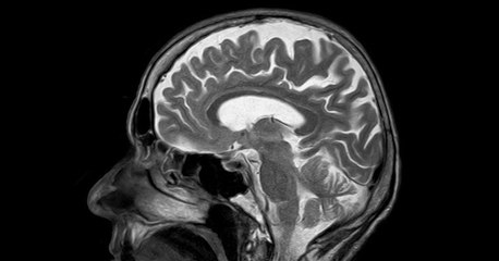 Maladie de Charcot : symptômes, causes, traitement, où en est-on ?