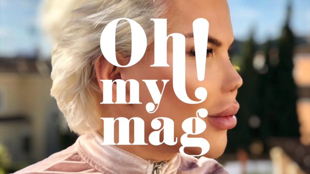 11 plastic surgeries later, the Human Ken Doll's nose has totally collapsed