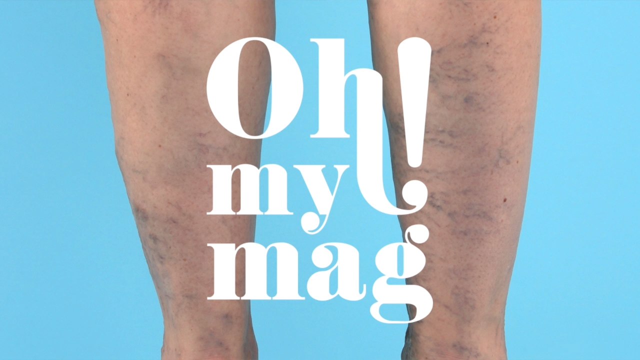 This Natural Remedy Will Finally Help You Get Rid Of Your Varicose Veins