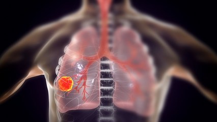 Forschende warnen: Ein Lebensmittel regt das Wachstum von Krebszellen an