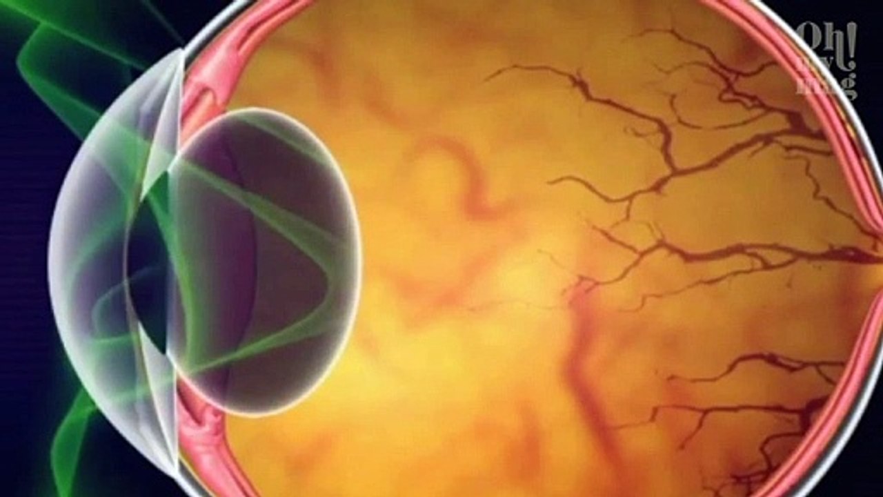 Neue Volkskrankheit: Darum werden immer jüngere Menschen kurzsichtig