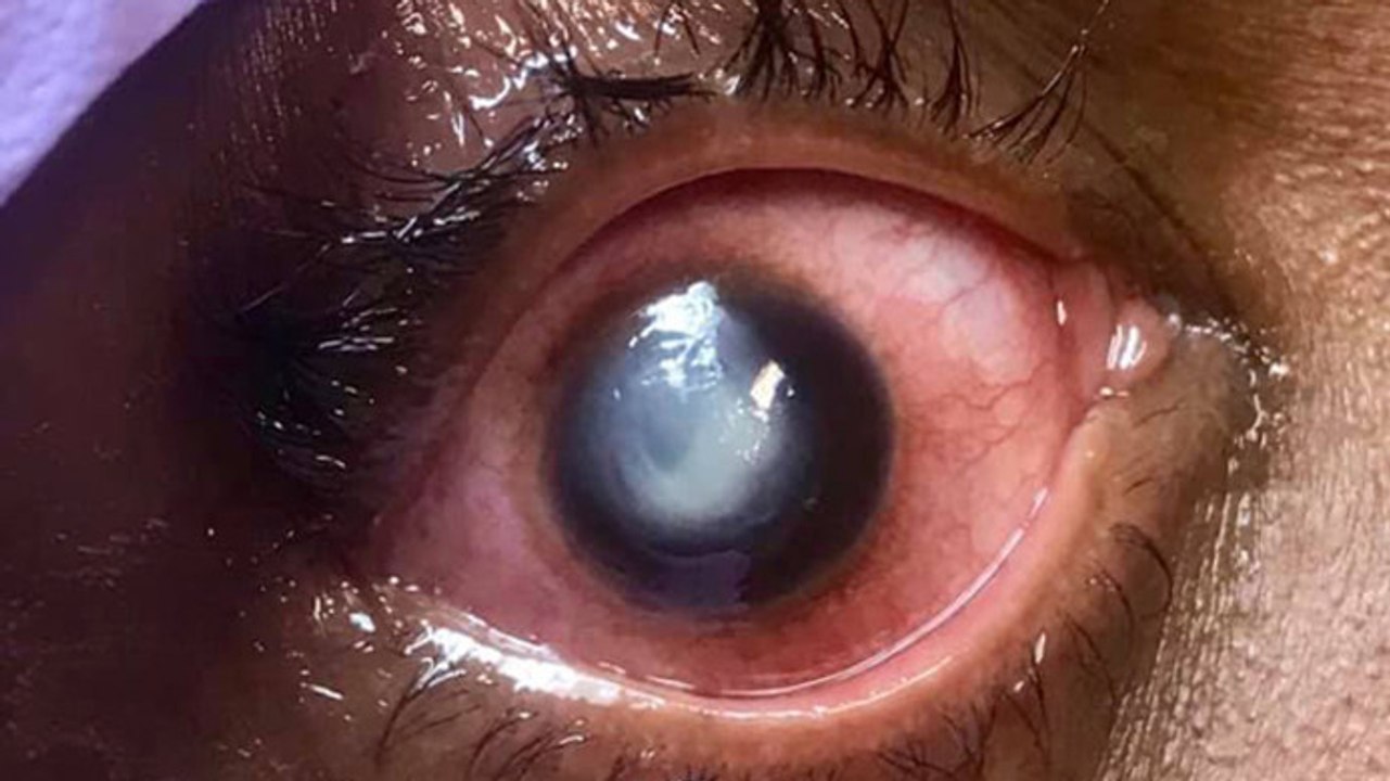 Darum solltest du immer deine Kontaktlinsen vorm Schlafengehen entfernen