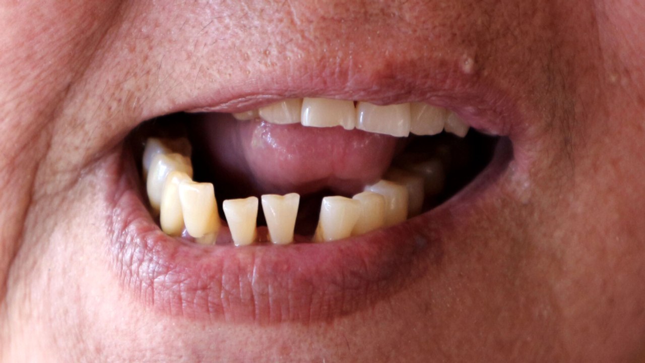 Schiefe Zähne: So wirken sie sich auf deine Gesundheit aus