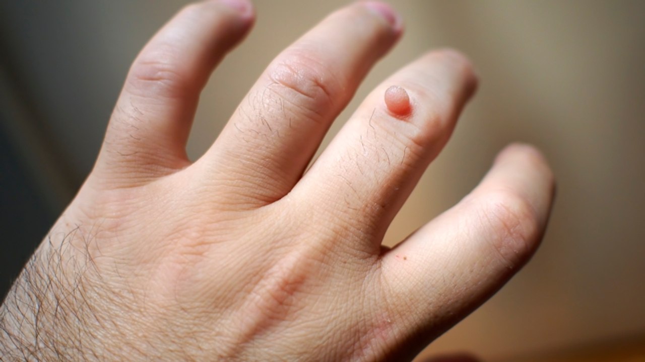 Stielwarzen natürlich entfernen: Mit diesem Hausmittel klappt es ganz einfach