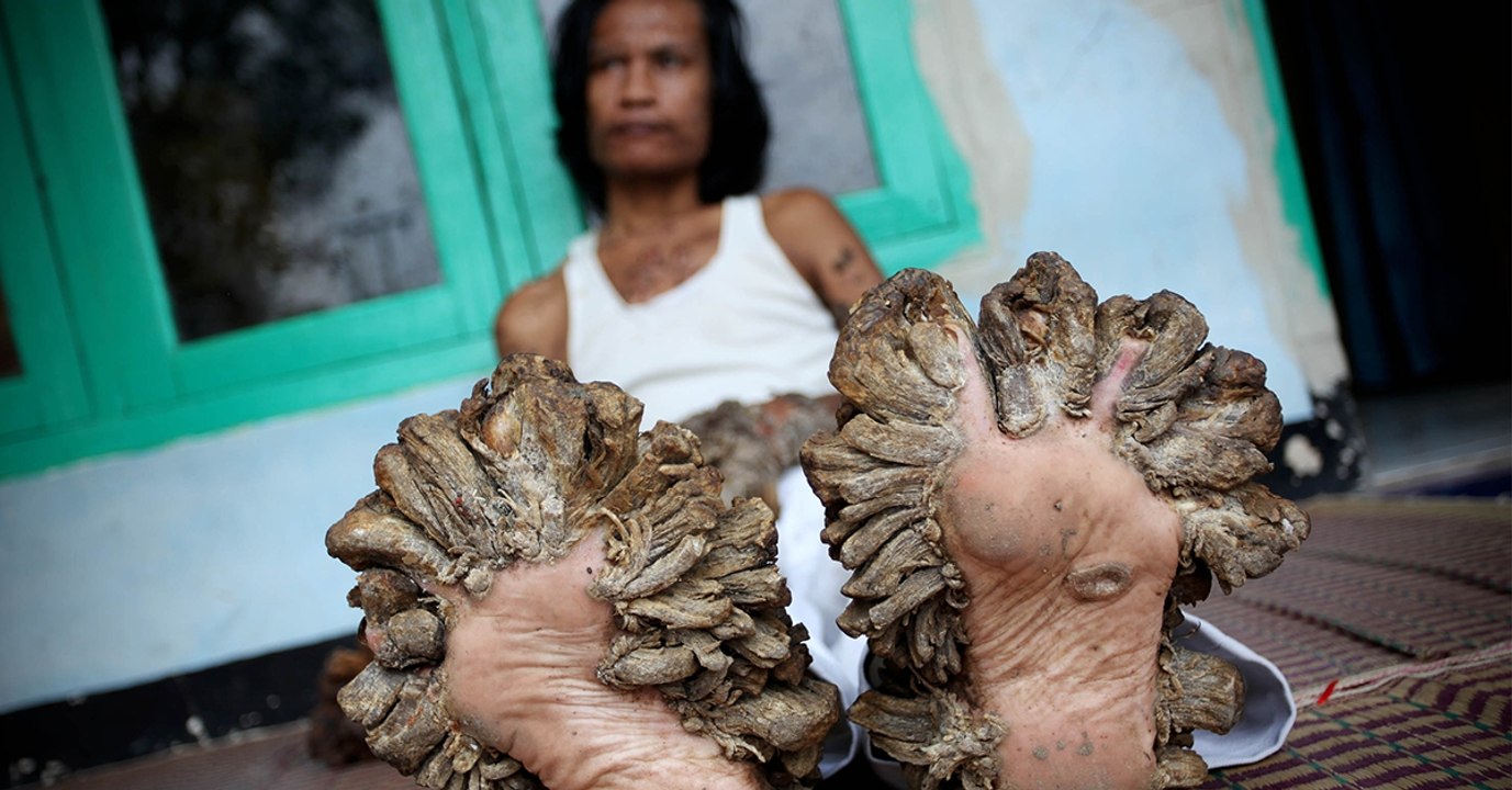 Der Baummann von Java: Seine Krankheit verwandelt ihn in einen Baum