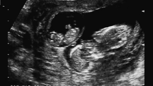 Superfötation: Jessica Allen bekommt zwei Kinder auf einmal - doch es sind keine Zwillinge