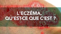 Eczéma : traitement, causes, définition et symptômes, que faire face à cette maladie de peau ?