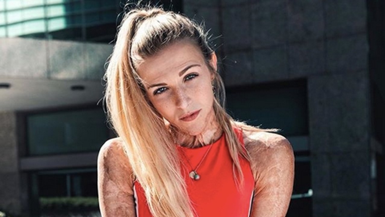 Brandopfer: Die tapfere Julie wird zur Influencerin