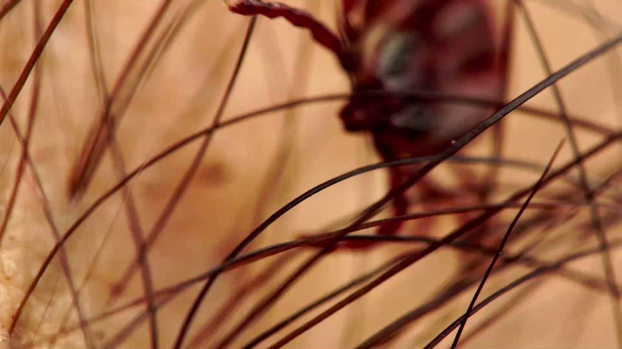 Gefährliche Zeckenart mit gestreiften Beinen überträgt neben der Lyme-Borreliose eine zweite Krankheit