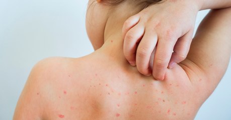 Rougeole : symptômes, contagion, traitement, vaccin, de quoi s'agit-il ?