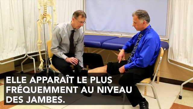 Phlébite : symptômes, causes et traitement de la thrombose veineuse