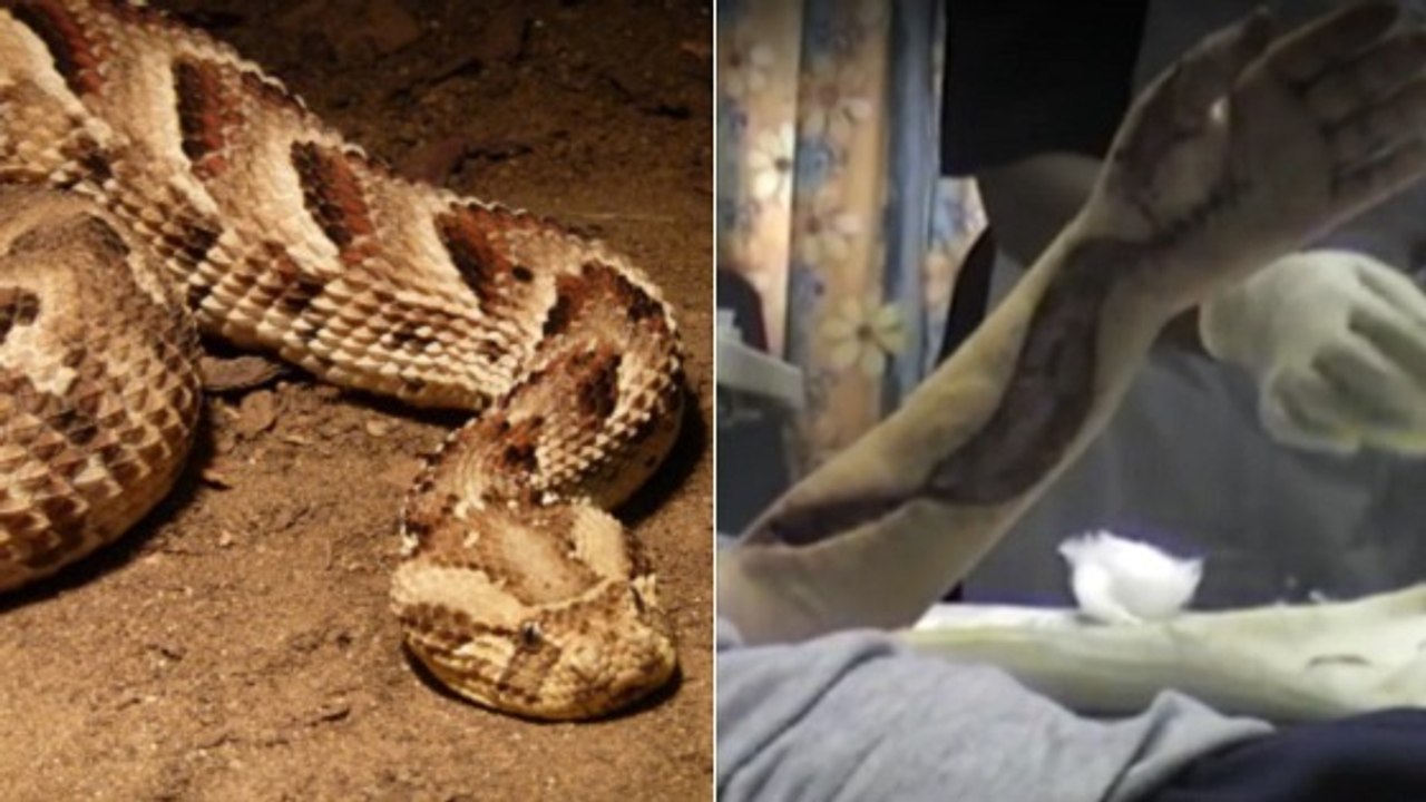 Un homme dévoile l'effrayant effet d'une morsure de vipère heurtante