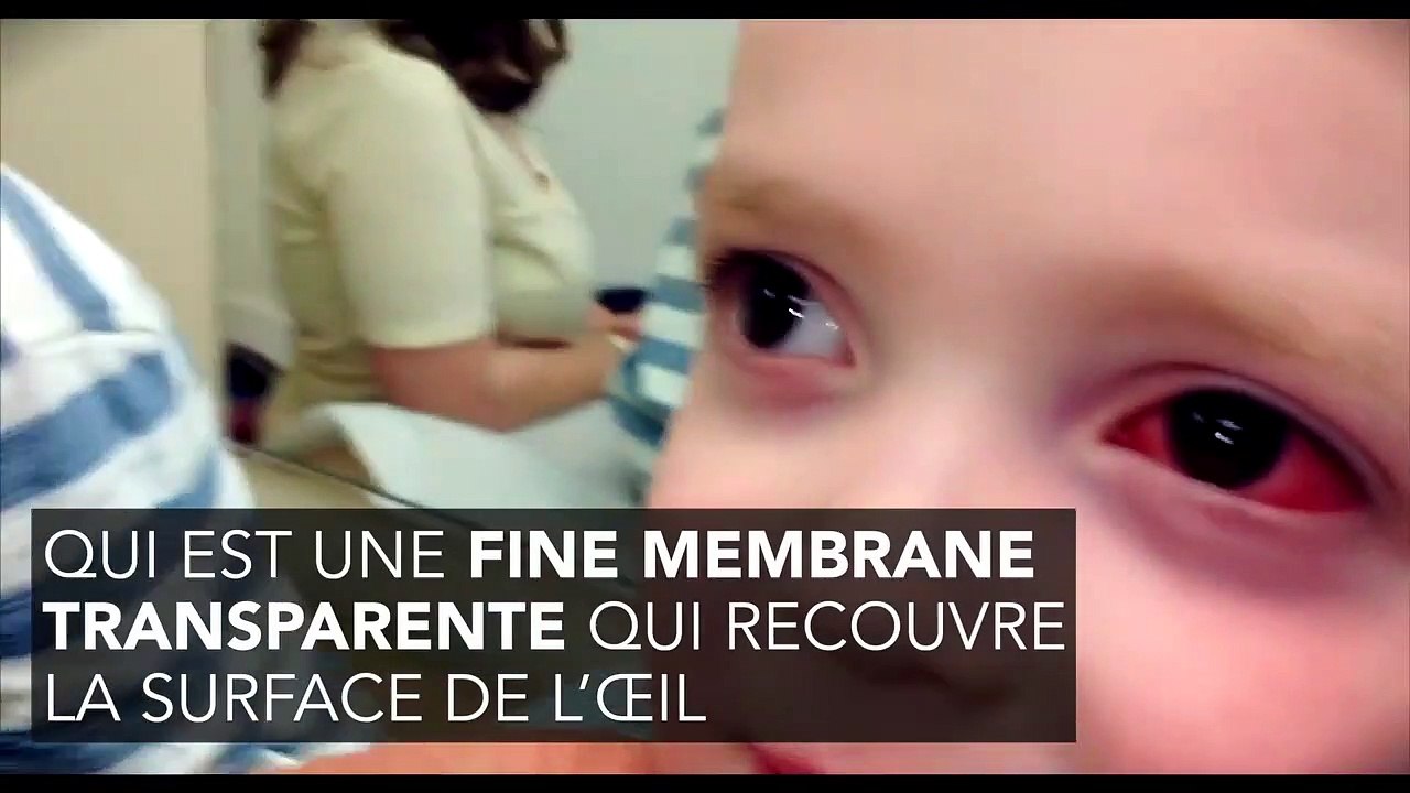 Conjonctivite : traitement, symptômes, durée, comment la soigner ?