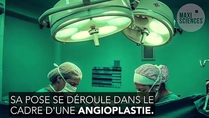 Stent : actif ou nu, comme se déroule la pose d'un stent ?