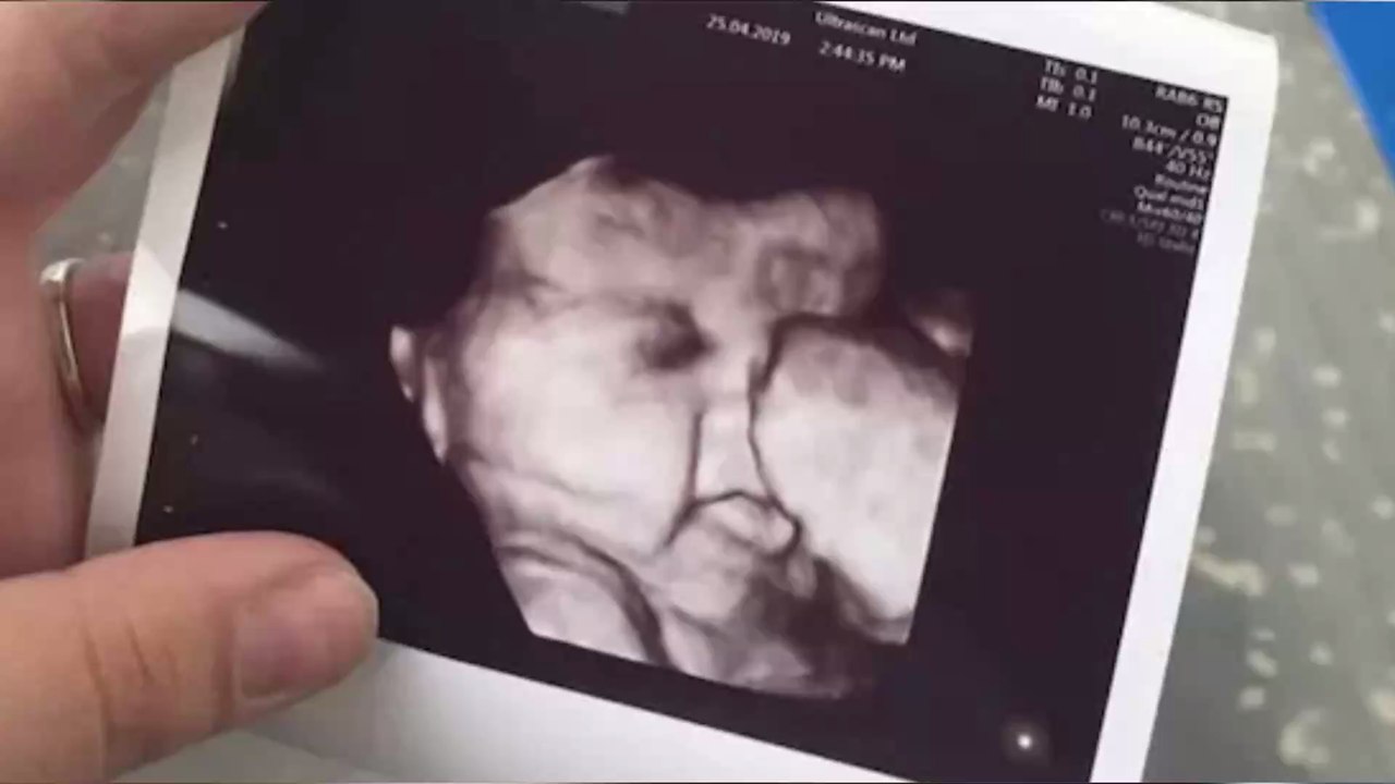 Pregnant Woman Left Astonished When She Saw Her 34 Week Scan