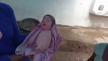 Doctors were left baffled as a baby Born in India was missing all four limbs