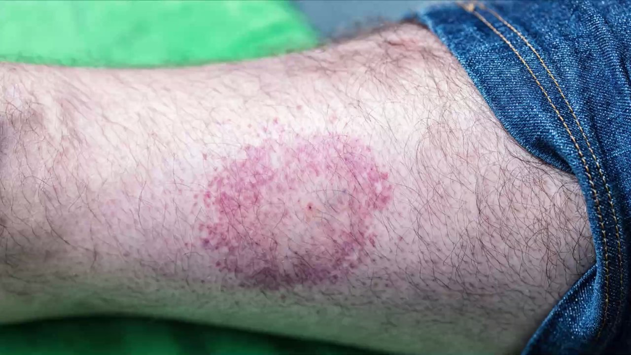 Maladie de Lyme : symptômes, traitement, photo, diagnostic, de quoi s'agit-il ?