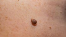 You can easily get rid of skin tags with this simple home remedy