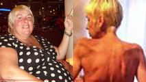 Woman Left Weighing Only 6 Stone After Gastric Bypass Surgery Goes Wrong