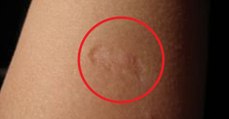 Voici la signification de la petite cicatrice présente sur le bras de certaines personnes