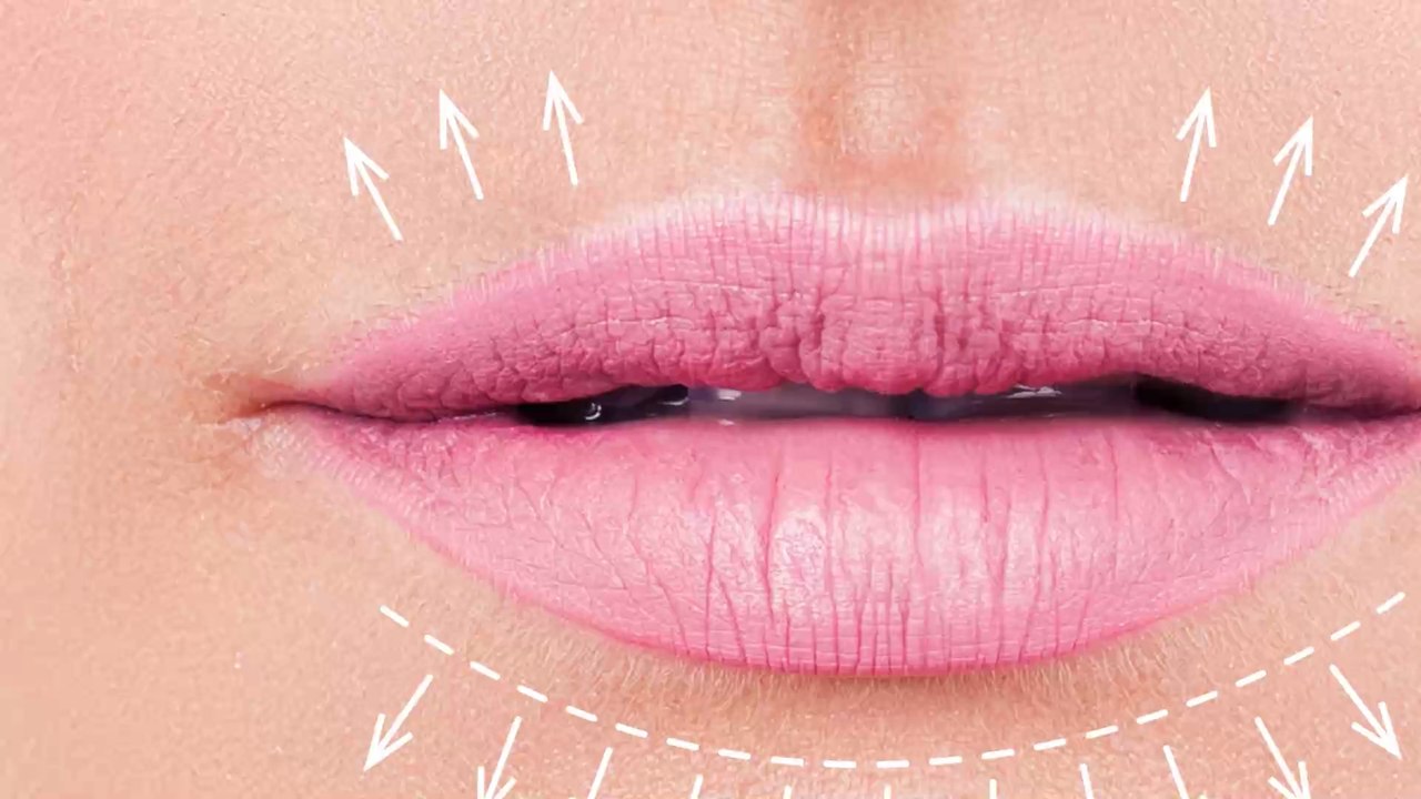 'Zwei Jahre Qualen': Wegen billigem Füller platzten Lippen einer Mutter fünf Mal auf