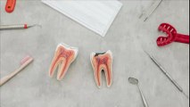 Carie dentaire : traitement, soins, causes, conséquences, que faire ?