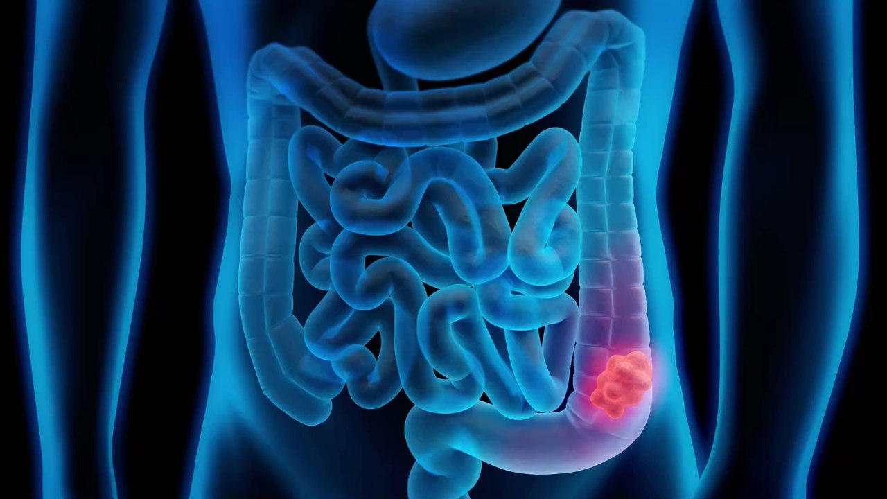 Anzeichen von darmkrebs: auch müdigkeit gehört zu den vielen symptomen