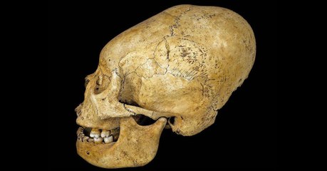 Le mystère des crânes allongés découverts au Pérou enfin dévoilé ?