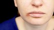 Cold sores: Why you often get mouth sores or canker sores