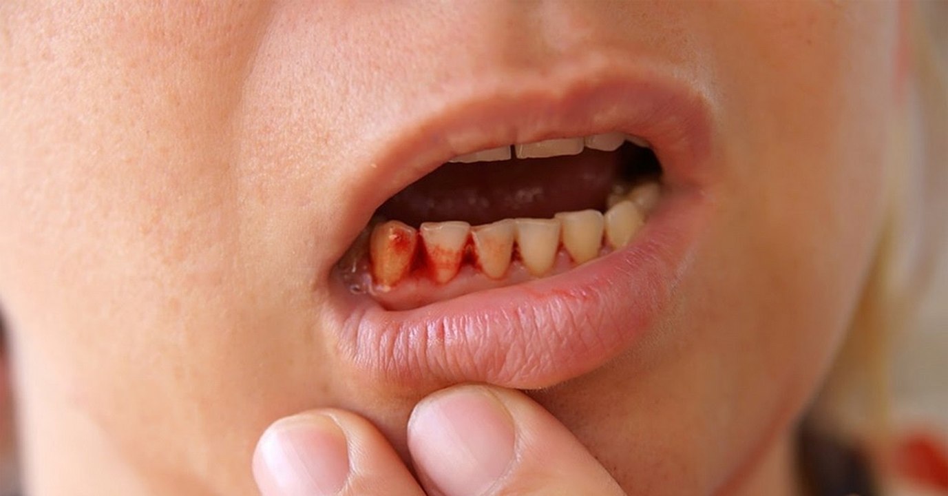 Scorbut : la maladie mortelle du 18ème siècle fait sa réapparition dans les pays développés