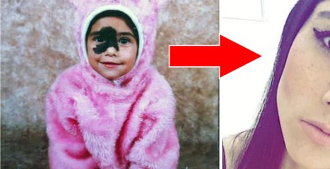 Woman covered in birthmarks learns to embrace her unique look