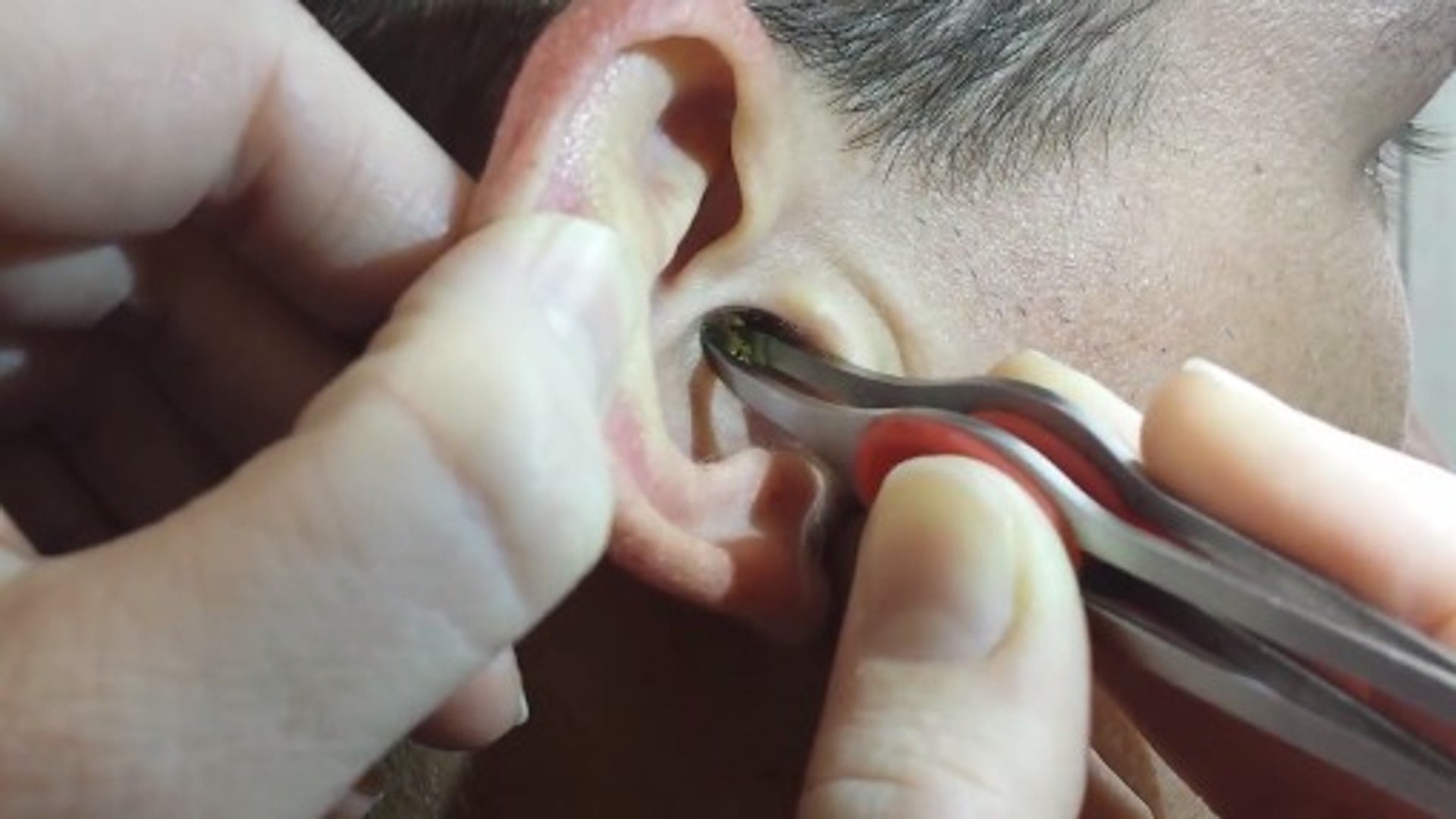 Comment enlever un bouchon d'oreille ? - Conseils Santé