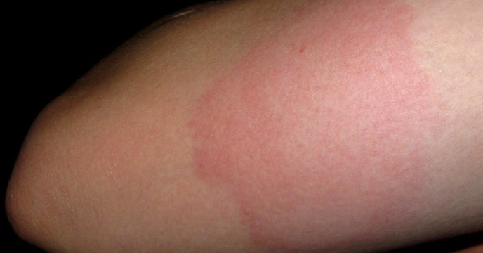 Désensibilisation : allergie, chat, acariens, pollen, chien, effets secondaires