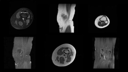 Ostéosarcome : définition, symptômes, traitement... de quoi s’agit-il ?