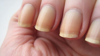 L'état de vos ongles peut traduire votre état de santé !