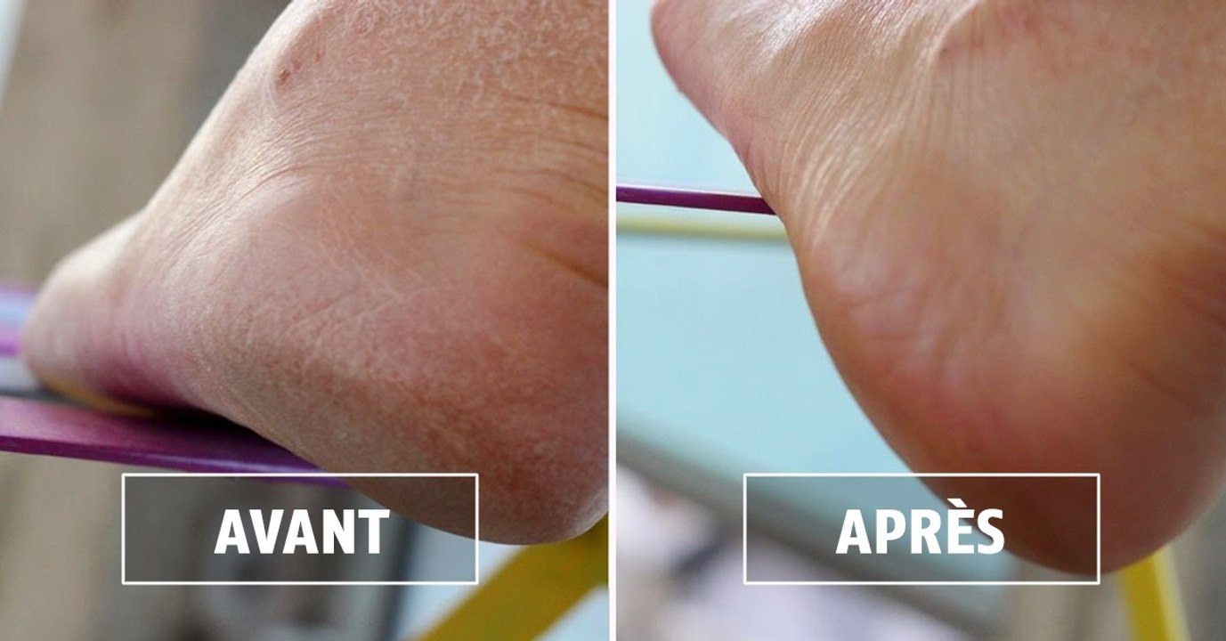 Corne sous les pieds : comment s'en débarrasser ?