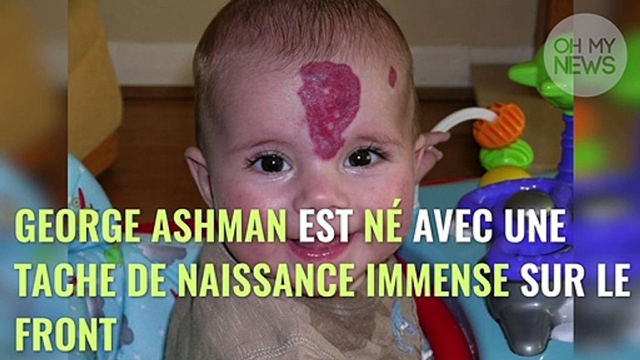 Une maman décide de faire opérer son fils pour faire disparaître sa tache de naissance