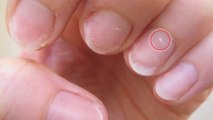 Leuconychie : cette maladie méconnue entraîne l'apparition de petites taches blanches sur vos ongles
