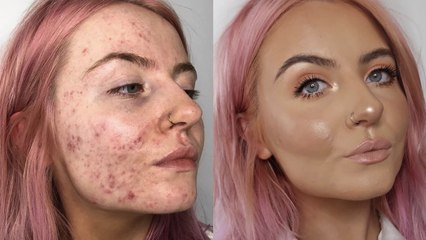 Acné : un avant/après choquant grâce à cette marque de make-up