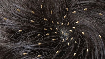 Un passager filme une femme dans le bus avec une tête pleine de poux (VIDEO)