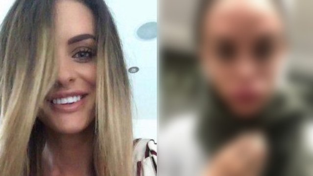 Insolite : ses lèvres quadruplent de volume après avoir fait une injection de botox (VIDÉO)