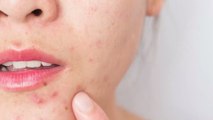 Cette femme brise les tabous et affiche fièrement son visage envahi par l'acné ! (PHOTOS)