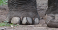 Linfedema: El problema de salud que te hace tener "pies de elefante"