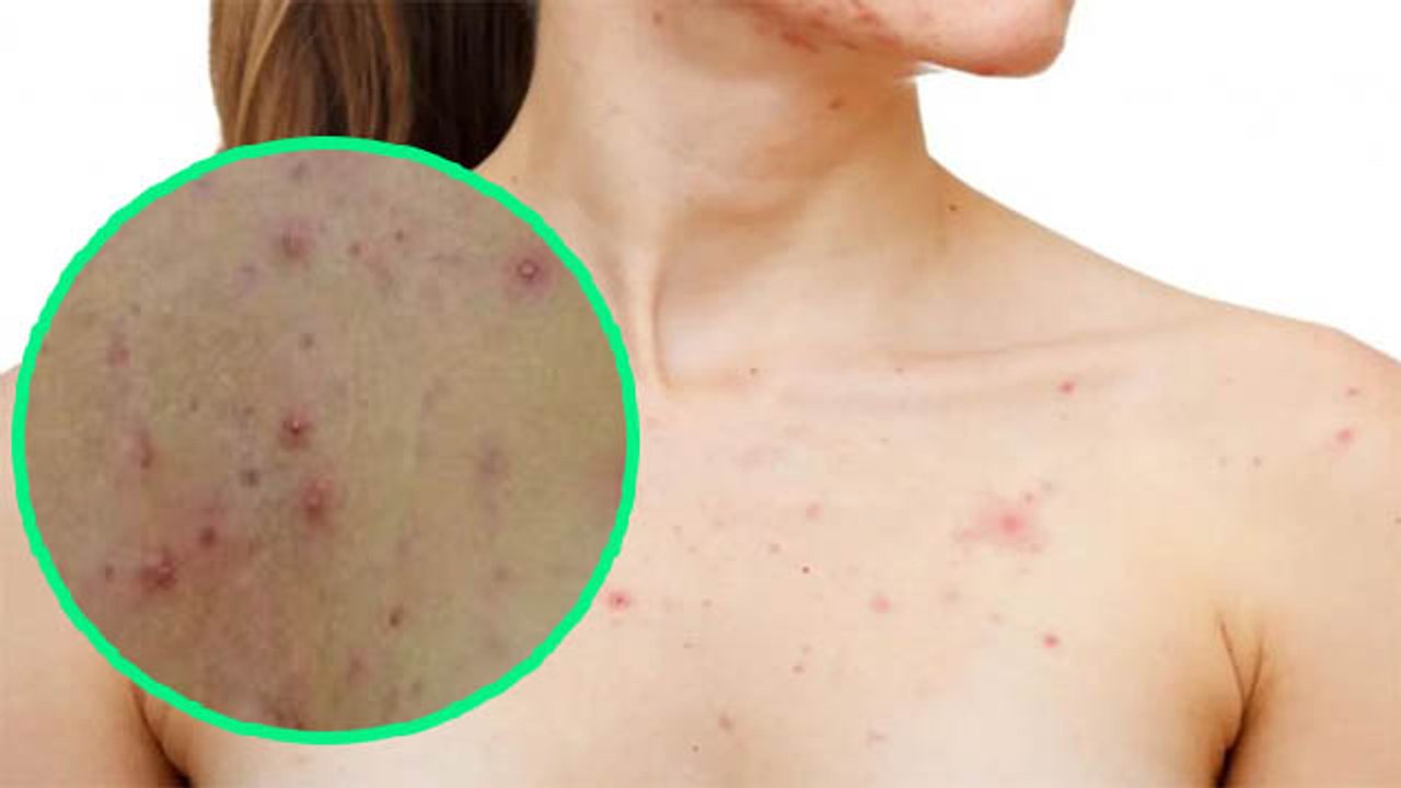 छाती पर पिंपल क्यों होता है | क्या है chest Acne के कारण और उपाय | oldsky