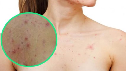 छाती पर पिंपल क्यों होता है | क्या है chest Acne के कारण और उपाय | oldsky
