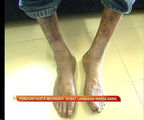 Pengidap kusta meningkat akibat lambakan warga asing